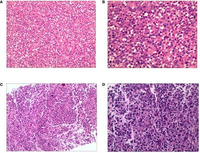 Case report: The utilization of crizotinib and brentuximab vedotin as a bridge to autologous stem cell transplantation and followed by CD30-directed CAR-T cell therapy in relapsed/refractory ALK+ ALCL